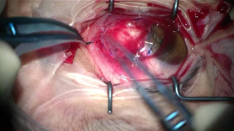 This clinical photograph captures an intraoperative view of an ophthalmological procedure, likely a pterygium excision with amniotic membrane transplantation. The eye is secured with a metal wire lid speculum, exposing the surgical field. The conjunctiva exhibits marked hyperemia and vascular congestion. Centrally, a corneal graft or amniotic membrane is visible, partially tucked under a created conjunctival pocket. Two surgical instruments are in use: a pair of Colibri or non-toothed forceps on the left is grasping and manipulating the conjunctival edge, while a second slender instrument on the right assists in positioning. A large, transparent therapeutic bandage contact lens is placed over the cornea and the graft site to provide tectonic stability and promote epithelialization. The white sclera is visible beneath the dissected tissue layers. This image demonstrates key steps in ocular surface reconstruction and the use of bandage lenses for postoperative graft protection.