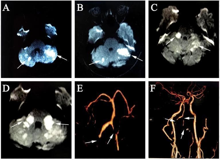 A multi-panel figure containing radiological studies for a case of posterior circulation stroke. (A-D) Axial diffusion-weighted imaging (DWI) MRI frames demonstrate progressive ischemic changes. Panels A and B (Day 3) show multifocal hyperintense areas within the bilateral cerebellar hemispheres, consistent with acute infarction. Panels C and D (Day 10) illustrate new, confluent hyperintensities extending into the bilateral middle cerebellar peduncles (MCP), indicating evolving infarcts. Arrows highlight the specific foci of restricted diffusion. (E, F) 3D reconstruction and coronal views from a computed tomography angiography (CTA) of the head and neck. These vascular images reveal significant pathology of the vertebrobasilar system, including total occlusion of the bilateral vertebral artery (VA) at the V3 and proximal V4 segments, as well as occlusion of both anterior inferior cerebellar arteries (AICA). Severe focal stenosis is also visible in the distal left VA V4 segment. This series provides a diagnostic correlation between multi-segment arterial occlusion and bilateral cerebellar territory infarction.
