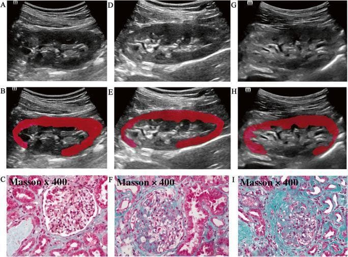 A nine-panel comparison figure illustrating the correlation between B-mode ultrasound imaging and histopathology in chronic kidney disease (CKD) across varying severities of interstitial fibrosis and tubular atrophy (IFTA).
Panels A, D, and G present longitudinal B-mode ultrasound scans of the kidney. Progressing from mild (A) to severe (G) IFTA, the images demonstrate increasing cortical echogenicity, textural heterogeneity, and a progressive loss of corticomedullary differentiation. Panels B, E, and H show the same ultrasound scans with superimposed red regions of interest (ROI) generated via ITK-SNAP software for cortical radiomics analysis.
Panels C, F, and I display corresponding kidney biopsy specimens with Masson’s trichrome staining (x400 magnification). Panel C (mild IFTA) shows preserved tubular architecture and minimal collagen. Panel F (moderate IFTA) exhibits increased interstitial collagen (blue staining) and early tubular atrophy. Panel I (severe IFTA) demonstrates extensive interstitial fibrosis, marked tubular atrophy, and glomerular sclerosis. This comparison highlights the visual indicators of renal structural decline used for non-invasive IFTA staging.