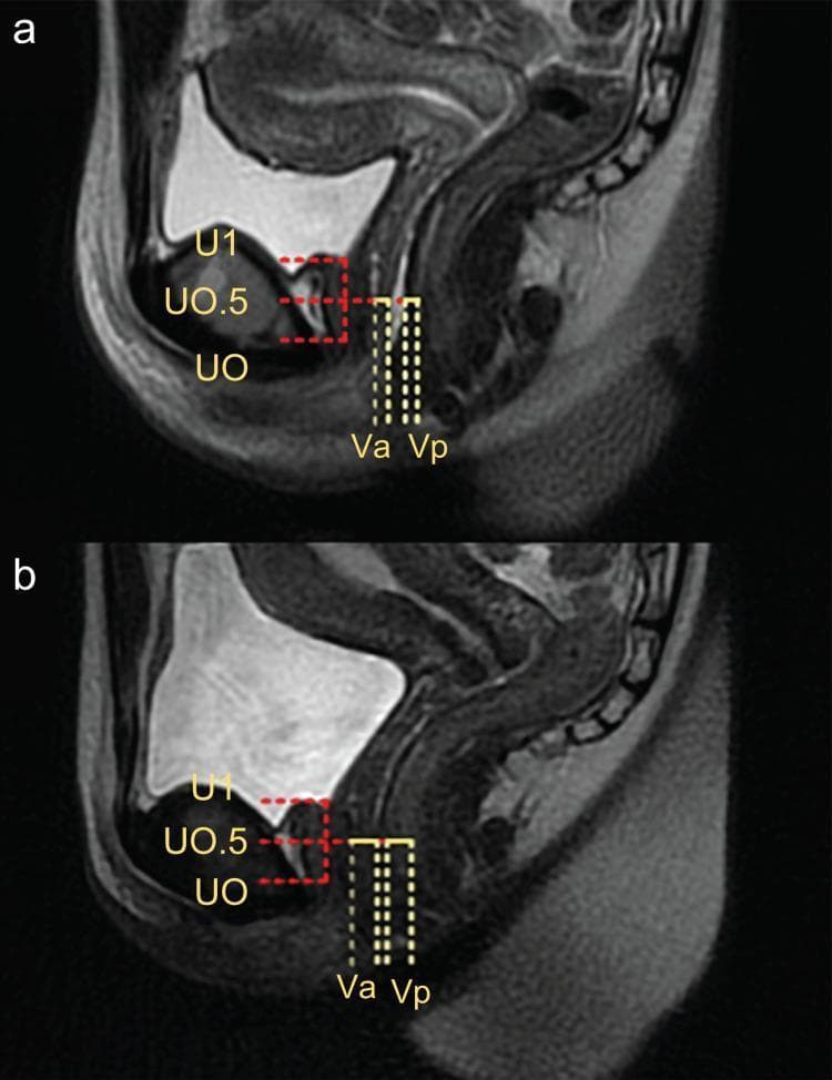 This diagnostic image consists of two sagittal T2-weighted magnetic resonance imaging (MRI) scans of the female pelvic floor, comparing anatomy before (a) and after (b) treatment for stress urinary incontinence (SUI). The images focus on the mid-urethra and vaginal wall interface. Key anatomical landmarks are labeled: U1 represents the upper end of the urethra (vesicourethral boundary), U0 marks the lower end (urethral opening), and U0.5 indicates the midway point. In image (a), representing the baseline (T0), the anterior (Va) and posterior (Vp) vaginal walls measured at the level of U0.5 appear thinner with a combined thickness of approximately 8 mm. In image (b), representing the post-treatment state (T3), there is a visible increase in the combined thickness of the Va and Vp to approximately 12 mm, suggesting tissue remodeling or swelling. A red dotted box highlights the adipose tissue space and urethral morphology, which shifts from an elliptical shape in (a) to a more circular configuration in (b). The image illustrates the anatomical changes associated with laser therapy in the management of pelvic floor disorders.