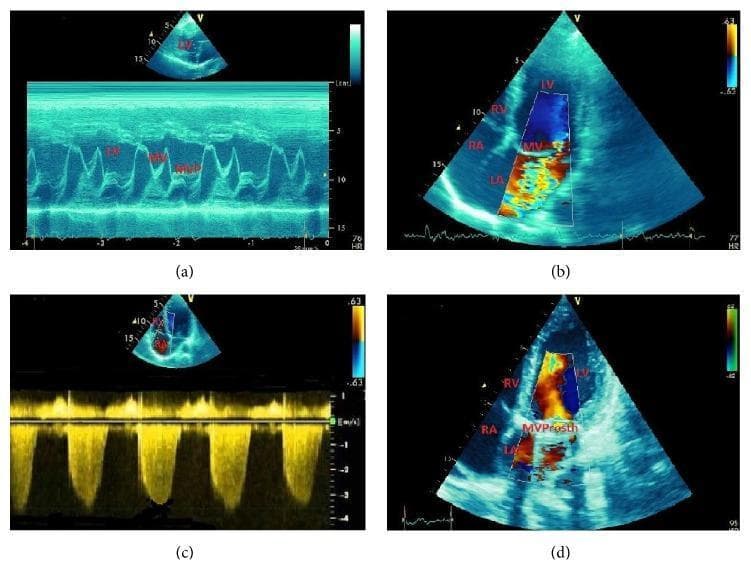 This composite of four echocardiographic images illustrates the diagnostic features and surgical outcome of mitral valve prolapse (MVP). Image (a) presents an M-mode echocardiogram showing characteristic late-systolic posterior displacement of the mitral valve (MV) leaflets, diagnostic of MVP. Image (b) shows a 2D color Doppler in an apical four-chamber view, demonstrating a large, turbulent mosaic jet of mitral regurgitation (MR) originating from the mitral valve and filling a significant portion of the left atrium (LA). Image (c) displays continuous-wave Doppler measurement used to estimate systolic pulmonary artery pressure (SPAP), which is elevated at 58 mmHg, indicating secondary pulmonary hypertension. Image (d) illustrates a postoperative apical four-chamber view following mitral valve replacement with a mechanical prosthesis (labeled 'MVProsth'). The color Doppler shows a significant reduction in regurgitation, with only minor physiologic jets visible. These images collectively demonstrate the progression from valvular pathology to hemodynamic consequences and eventual surgical correction in a patient with congenital MVP and severe MR.