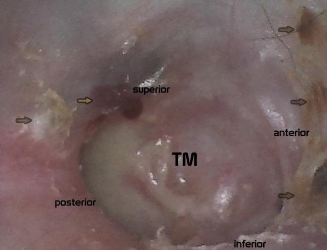 This clinical otoscopic photograph displays a reconstructed tympanic membrane (TM) 24 months post-surgery, likely following a tympanoplasty for chronic otitis media or cholesteatoma. The central reconstructed membrane appears intact, pinkish-white, and opaque, exhibiting visible vascularity and a smooth surface. Anatomical orientation is provided by 'superior', 'anterior', 'inferior', and 'posterior' labels. Key findings include a localized, dark red small hematoma located in the superior-posterior region, identified as an iatrogenic artifact from recent ear cleaning. Furthermore, multiple yellowish-white, irregular patches of keratinized surface epithelium remains are visible, particularly along the posterior and anterior margins of the ear canal and graft junction. The image serves as an educational tool for post-operative monitoring of middle ear reconstruction, illustrating normal graft healing and the identification of non-pathological artifacts versus potential disease recurrence.