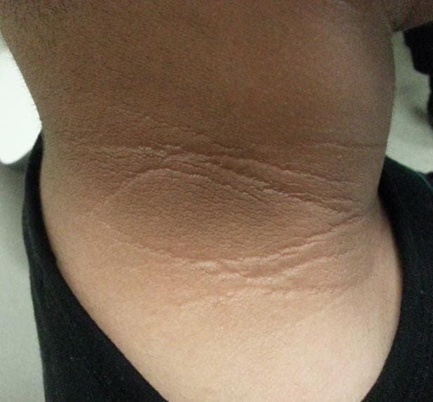 Clinical photograph of the posterior and lateral aspect of a patient's neck demonstrating classic features of acanthosis nigricans. The affected skin shows significant hyperpigmentation and symmetric, velvety thickening (lichenification) with prominent, exaggerated skin folds. The texture appears roughened and 'dirty' in appearance, with the most intense darkening occurring within the deeper cutaneous creases. The boundaries of the lesion are poorly defined, blending gradually into the surrounding normal skin. This dermatological manifestation is a key clinical marker often associated with systemic conditions such as insulin resistance, type 2 diabetes mellitus, and metabolic syndrome, or as part of specific genetic syndromes like Alström syndrome. The image serves as an educational example of metabolic-related skin changes and is essential for clinical recognition and diagnosis in endocrinology and dermatology.