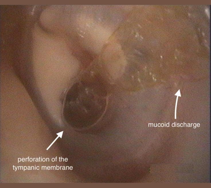 This clinical otoscopic photograph of a left ear demonstrates signs of chronic otitis media (COM). The image clearly shows a large, central perforation of the tympanic membrane, appearing as a dark, circular void where the membrane should be intact. Adjacent to this perforation, there is visible mucoid discharge, which presents as a translucent, glistening, and somewhat viscous fluid resting on the membrane surface. Additionally, white, opaque areas consistent with tympanosclerotic plaques are visible on the remaining portions of the tympanic membrane, indicating previous inflammation or scarring. The external auditory canal appears mildly erythematous. This visual is characteristic of chronic suppurative otitis media, an important educational example for distinguishing types of membrane perforations and associated middle ear pathology. The presence of discharge and structural changes in the membrane are key diagnostic markers used by otorhinolaryngologists to assess disease chronicity and planning for potential tympanoplasty.
