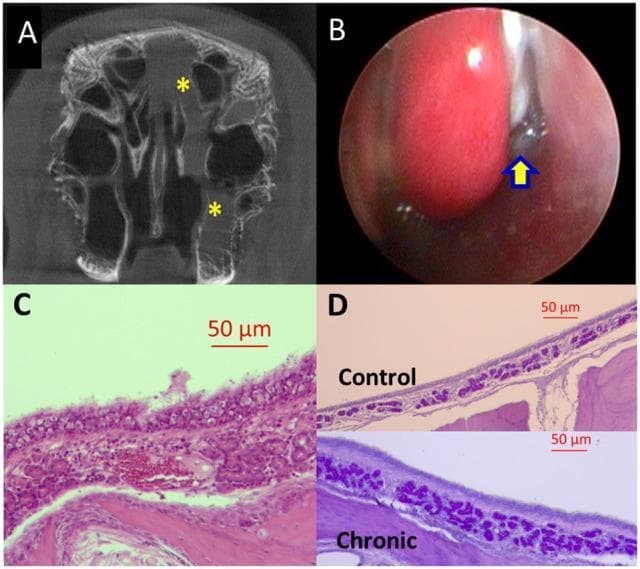 Educational visual panel depicting a rabbit model of chronic rhinosinusitis (CRS) at 14 weeks. (A) Coronal micro-CT scan of the paranasal sinuses demonstrating partial opacification of the left maxillary and ethmoid sinuses (yellow asterisks), indicating fluid or mucosal thickening. (B) Nasal endoscopy image showing the left middle meatus with purulent secretions (yellow arrow) positioned between the middle turbinate and the lateral nasal wall. (C) H&E stained histopathology slide showing significant infiltration of chronic inflammatory cells (plasma cells and lymphocytes), epithelial hyperplasia, and submucosal edema. (D) Periodic Acid-Schiff (PAS) stained comparison between control (upper) and chronic sinusitis (lower) tissue. The chronic group exhibits marked hypertrophy and increased density of submucous glands, staining deep purple, which characterizes mucus hyperplasia. This composite illustrates diagnostic imaging, clinical findings, and microscopic cellular changes associated with long-term sinus inflammation.