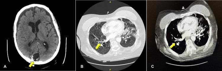 This composite of three axial computed tomography (CT) images illustrates post-treatment clinical findings in a patient with multi-organ pathology. Figure A is a non-contrast brain CT scan showing a right occipital craniotomy site. The surgical cavity is identifiable, surrounded by irregular linear hyperdensities (suggestive of acute post-operative hemorrhage) and areas of low-attenuation consistent with diffuse vasogenic edema over the parietal convexity. Figures B and C are CT angiography (CTA) images of the chest in lung and mediastinal windows, respectively. Yellow arrows indicate subsegmental filling defects within the right upper lobe pulmonary vasculature, diagnostic of small-volume pulmonary emboli (PE). The lung parenchyma adjacent to the emboli shows mild irregularities without dense consolidation. These images highlight the clinical challenge of managing systemic thromboembolic disease in the immediate post-operative period following neurosurgery, where the risk of intracranial hemorrhage complicates anticoagulation therapy. The educational focus is on identifying post-surgical intracranial complications and vascular filling defects on CTA.