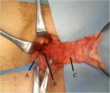 This intraoperative clinical photograph captures a surgical repair of a right internal inguinal hernia (supravesical hernia). The image shows the open surgical field with various anatomical structures labeled for educational identification. The spermatic cord (A) is visible as a reddish-brown bundle of tubular structures, isolated and retracted with a blue vessel loop and surgical instruments. Centrally, the hernia orifice (B) is identified as a dark, recessed opening on the posterior wall of the inguinal canal near the vesical side. A distended, pale pink membranous structure represents the hernia sac (C), which has been dissected and is being held outward by surgical clamps. Metal retractors are positioned to maintain visualization of the inguinal canal anatomy. The image demonstrates the spatial relationships between the cord structures and the hernia defect during a Lichtenstein-type repair, highlighting the surgical anatomy of the inguinal region in a patient with a supravesical-type hernia.