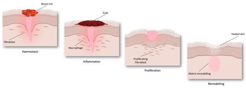 An anatomical pathophysiology diagram illustrating the four sequential stages of cutaneous wound healing: haemostasis, inflammation, proliferation, and remodeling. The illustration depicts a cross-section of the skin layers (epidermis and dermis). During 'Haemostasis', a red blood clot forms on the surface above a funnel-shaped injury, with fibroblasts visible in the surrounding dermis. In the 'Inflammation' stage, a dark-colored scab replaces the initial clot, and macrophages are identified in the underlying tissue. The 'Proliferation' stage demonstrates the formation of pinkish granulation tissue filling the wound gap, accompanied by 'proliferating fibroblasts' migrating into the site. Finally, the 'Remodeling' stage shows 'healed skin' with a restored epidermal surface and an underlying zone of 'matrix remodeling' replacing the previous injury site. The diagram serves as an educational summary of tissue repair mechanisms and cellular involvement at different phases of recovery.