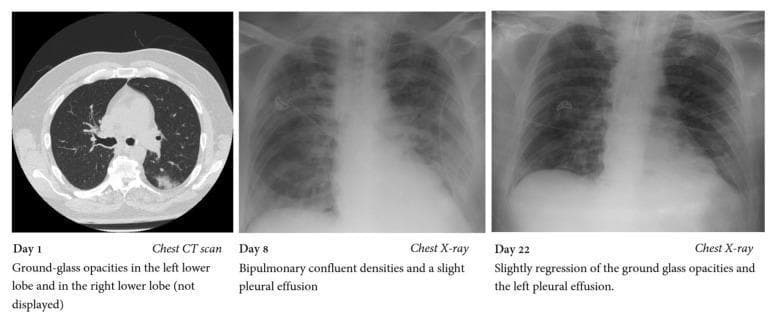 This composite educational image illustrates the progression and partial resolution of pulmonary pathology in a patient with COVID-19 ARDS and secondary fungal infection. Panel 1 (Day 1) shows an axial chest CT scan section demonstrating localized ground-glass opacities (GGOs) primarily in the posterior aspect of the left lower lobe. Panel 2 (Day 8) is an anteroposterior (AP) chest X-ray revealing significant disease progression, characterized by extensive bipulmonary confluent densities and signs of a slight bilateral pleural effusion, consistent with peak Acute Respiratory Distress Syndrome (ARDS) manifestation. Panel 3 (Day 22) is a follow-up AP chest X-ray showing slight regression of the bilateral confluent opacities and a reduction in the volume of the left pleural effusion. This temporal comparison highlights common radiological patterns in viral pneumonia, including the transition from focal ground-glass findings on CT to diffuse consolidation on X-ray, and subsequent monitoring of treatment response or secondary complications.