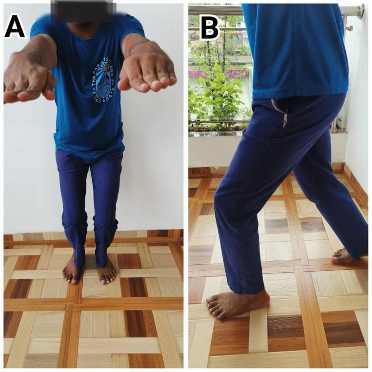 Two-panel clinical photograph demonstrating therapeutic rehabilitation exercises for a patient following Anterior Cruciate Ligament Reconstruction (ACLR). The images illustrate components of the Schlechter Protocol of Youth Sports and Orthopedics. Image A (left) shows the patient from a frontal view performing a mini squat. The patient is standing with feet shoulder-width apart, knees slightly flexed, and arms extended forward at shoulder level for balance. Image B (right) shows the patient from a lateral profile performing a forward lunge. The lead leg is flexed at the knee with the foot flat, while the trailing leg is extended posteriorly, demonstrating dynamic lower extremity stability and weight-bearing progression. These exercises are critical in post-surgical orthopedic rehabilitation to restore quadriceps strength, improve neuromuscular control, and regain joint range of motion. The educational focus is on the correct execution of closed-chain kinetic exercises used in the intermediate phases of post-operative ACL recovery.