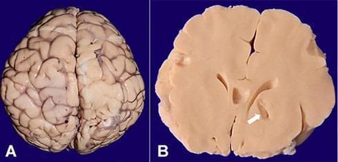 This composite clinical photograph displays two gross anatomical views of a human brain from an autopsy specimen. Figure A presents a superior (top-down) aspect of the cerebral hemispheres, showcasing the external surface morphology. The gyral pattern appears normal, with distinct gyri (ridges) and sulci (grooves) and no evidence of significant cortical atrophy or malformation. Figure B shows a coronal cross-section of the brain. A prominent white arrow indicates a localized cystic lesion located in the region of the right basal ganglia. The lesion is characterized by a loss of parenchymal tissue, consistent with an old cystic infarct. The surrounding anatomical landmarks, including the lateral ventricles and white matter tracts, are visible. The educational focus is on the gross pathological identification of focal brain lesions, such as infarcts, versus normal surface anatomy. This material is relevant to neuropathology and clinical neurology for studying the morphological manifestations of cerebrovascular accidents.