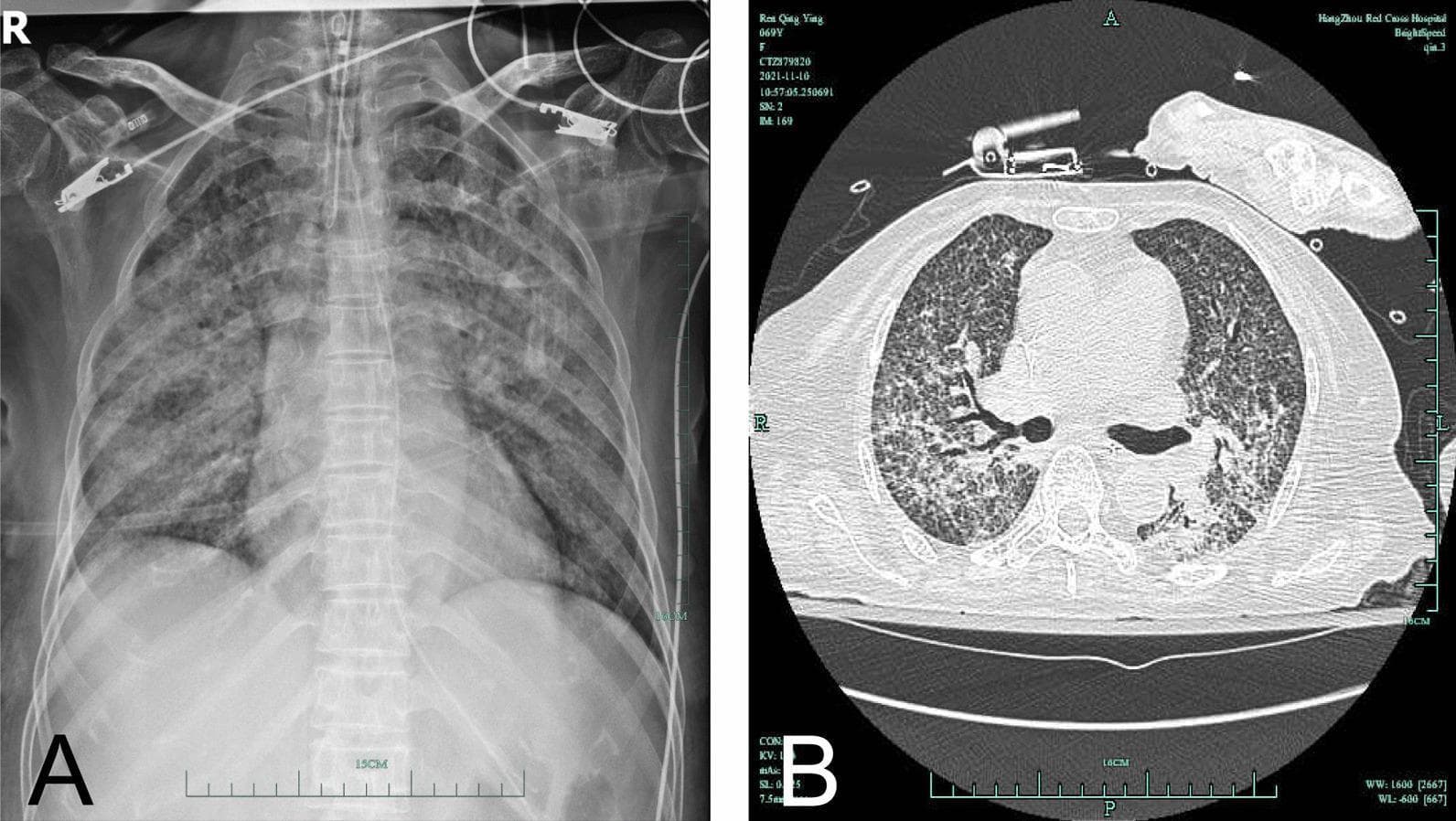 This composite diagnostic image displays chest findings in a 69-year-old patient with subacute hematogenous disseminated pulmonary tuberculosis. Panel A is an anteroposterior (AP) chest X-ray demonstrating a diffuse, bilateral reticulonodular pattern and increased lung markings, characterized by patchy infiltrations throughout both lung fields. An endotracheal tube and ECG leads are visible, indicating an intensive care setting. Panel B is an axial (transverse) section of a non-contrast chest CT scan (lung window) showing a classic miliary pattern. This is characterized by the diffuse, uniform distribution of innumerable tiny (1-3 mm), discrete micronodules throughout the lung parenchyma bilaterally. Some areas show partial fusion of these nodules, appearing as more confluent opacities. The radiographic and tomographic evidence is highly characteristic of miliary tuberculosis, representing hematogenous spread of Mycobacterium tuberculosis. The imaging serves as an educational example of severe pulmonary infectious disease and its manifestation across different imaging modalities.