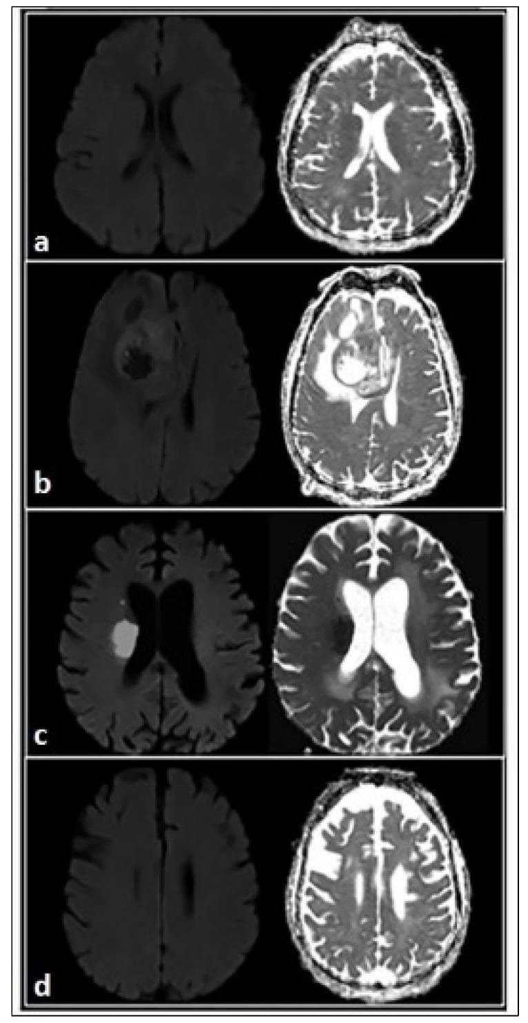 A comparison chart of axial brain Magnetic Resonance Imaging (MRI) demonstrating various pathologies using Diffusion-Weighted Imaging (DWI) on the left and corresponding Apparent Diffusion Coefficient (ADC) maps on the right. Row 'a' illustrates demyelination with increased ADC (bright signal on ADC map). Row 'b' displays an intracranial tumor showing restricted diffusion characterized by high DWI signal and low (dark) ADC signal, indicative of high cellular density. Row 'c' shows acute brain ischemia with cytotoxic edema, characterized by restricted diffusion (bright DWI, dark ADC) in a vascular distribution. Row 'd' represents gliosis or axonal loss, which presents as an increase in extracellular space resulting in elevated ADC values. This diagnostic visual facilitates the differentiation between cytotoxic edema (restricted diffusion) and vasogenic edema or tissue loss (increased diffusion), essential for neuroradiology education and clinical stroke or oncology assessment.