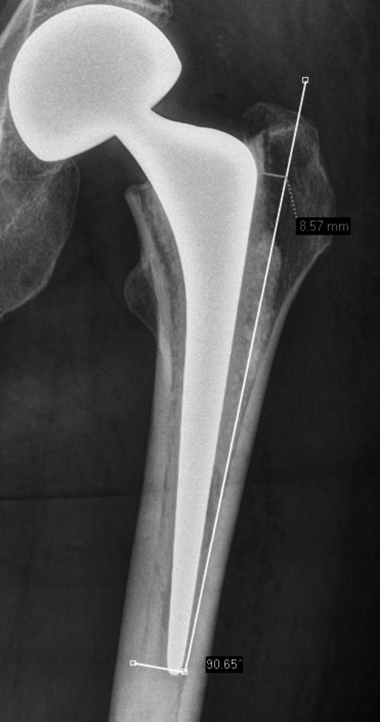 Anterior-posterior (AP) diagnostic X-ray of a proximal femur showing a bipolar hip hemiarthroplasty implant in situ. The image highlights the surgical assessment of the lateral femoral wall (greater trochanter) preparation. A longitudinal white reference line is drawn parallel to the femoral shaft axis along the medial border of the lateral femoral cortex. A horizontal measurement of 8.57 mm is indicated between this reference line and the lateral edge of the proximal femoral bone, demonstrating the thickness of the lateral wall that was not resected during stem preparation. At the distal end of the femoral stem, an angular measurement of 90.65 degrees is shown relative to the femoral axis to assess stem alignment. The radiopaque implant features a bipolar prosthetic head articulating with the native acetabulum and a medullary stem. The image serves as an educational tool for orthopedic surgery, specifically focusing on prosthetic fitting, rasping techniques, and the radiological evaluation of hemiarthroplasty component positioning relative to anatomical landmarks.