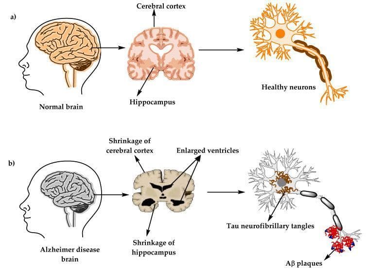 Educational comparison diagram illustrating the macroscopic and microscopic changes in the human brain associated with Alzheimer’s disease (AD). The visual is divided into two sections: (a) Healthy state and (b) Alzheimer’s disease state. At the macroscopic level, cross-sectional brain illustrations highlight a normal cerebral cortex and hippocampus versus a diseased brain showing significant shrinkage of the cerebral cortex, severe shrinkage of the hippocampus, and enlarged ventricles. At the microscopic level, the diagram compares neuronal morphology. Healthy neurons are depicted with intact cell bodies and axons. In contrast, the AD neuron demonstrates classic hallmarks of neurodegeneration: internal accumulation of tau neurofibrillary tangles (NFTs) within the cell body and the external deposition of amyloid-beta (Aβ) plaques around the axon terminals. This illustration serves to teach the pathophysiology of AD, focusing on structural atrophy and the proteinopathy involved in dementia progression. Key educational concepts include neuroanatomy, neurodegenerative pathology, and the amyloid/tau hypothesis.