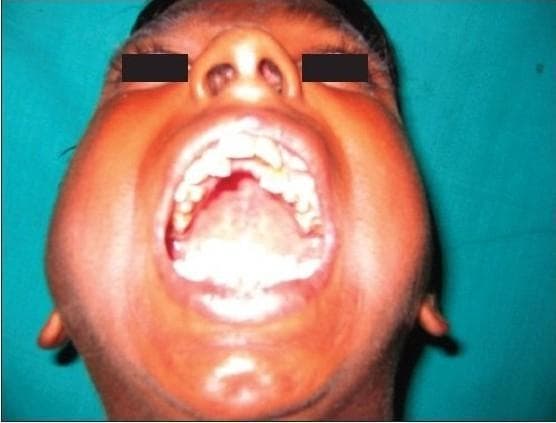 This clinical photograph provides a frontal, postoperative view of a patient’s face, demonstrating successful maximal mouth opening following surgical intervention for temporomandibular joint (TMJ) ankylosis. The patient is shown with the mouth wide open, revealing a significant interincisor distance, which serves as a clinical indicator of restored joint mobility and functional improvement. Within the oral cavity, the dentition, tongue, and oral mucosa are visible; some dental crowding and discoloration are present in the maxillary and mandibular arches. The facial contours show bilateral swelling along the cheeks and jawline, which is consistent with early postoperative inflammation. The eyes are masked with black bars for patient anonymity. This image serves as a clinical evaluation of the efficacy of interpositional arthroplasty—using techniques such as temporal fascia flaps or costochondral grafts—to resolve restricted mandibular movement caused by bony or fibrous ankylosis.