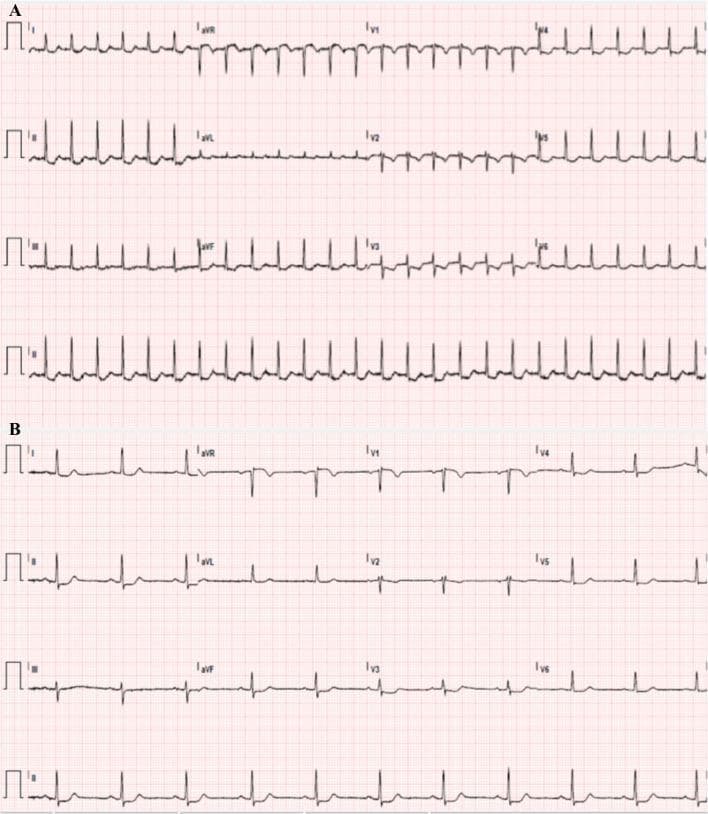 This diagnostic image consists of two 12-lead electrocardiogram (ECG) tracings, labeled Panel A and Panel B, comparing cardiac rhythms in the same patient. Panel A displays a supraventricular tachycardia (SVT), characterized by a rapid, regular heart rate with narrow QRS complexes and absent or obscured P waves. Panel B demonstrates the patient's transition to normal sinus rhythm. In this second tracing, the heart rate is significantly slower and regular, with clearly identifiable P waves preceding each QRS complex. A notable diagnostic finding in Panel B is the presence of ST-segment depressions, most prominent in leads II and V3 through V5, accompanied by T-wave flattening or inversion. These findings are clinically relevant for evaluating myocardial ischemia or strain following a tachyarrhythmia. The comparison is essential for cardiology and emergency medicine education, illustrating the spontaneous resolution of SVT and the subsequent identification of underlying repolarization abnormalities.