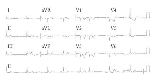This diagnostic image is a 12-lead electrocardiogram (ECG) demonstrating signs consistent with an acute inferoposterior myocardial infarction. The tracing shows sinus rhythm with intermittent heart block. Notable pathology includes significant ST-segment elevation in the inferior leads (II, III, and aVF), indicating an inferior wall injury pattern. Concurrently, there is evidence of reciprocal changes and posterior involvement, characterized by horizontal ST-segment depression and prominent asymmetric T-wave inversions across the precordial leads, specifically from V2 through V5. The T-wave inversion is most pronounced and deep in lead V2, with a gradual decrease in depth toward V5. These findings are critical for the diagnosis of ST-elevation myocardial infarction (STEMI) involving the inferior and posterior myocardial segments, often associated with occlusion or severe vasospasm of the right coronary artery or circumflex artery.