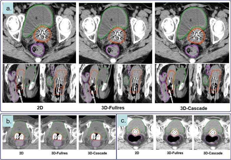 This diagnostic image set displays CT-based segmentation results for cervical cancer brachytherapy planning across three deep learning architectures: 2D, 3D-Fullres, and 3D-Cascade. The visualization compares manual ground-truth contours (solid lines) with auto-segmentation results (dashed lines) for critical structures: the bladder (green), rectum (purple), and High-Risk Clinical Target Volume (HRCTV, orange). The images are organized into three clinical scenarios based on the brachytherapy applicator used: (a) Needles and Tandem applicator, shown in axial, sagittal, and coronal planes; (b) Ovoid applicator in axial views; and (c) Vaginal multi-channel applicator in axial views. High-density metallic artifacts from the applicators are visible within the HRCTV. The comparison demonstrates the high level of spatial agreement between the automated AI models and expert manual segmentation for Organs at Risk (OARs) and target volumes, illustrating the clinical utility of nnU-Net frameworks in radiotherapy contouring workflows.