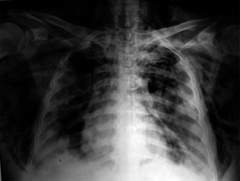 This diagnostic image is an anteroposterior (AP) chest x-ray radiography illustrating severe thoracic pathology. The primary findings include bilateral, predominantly peripheral patchy opacities and ground-glass densities throughout the lung fields, characteristic of atypical or viral pneumonia, such as COVID-19. Critical complications are evident: bilateral pneumothorax is indicated by the visualization of pleural lines with distal lucency lacking lung markings. Additionally, extensive subcutaneous emphysema is visible as characteristic streaky radiolucencies tracking through the soft tissues of the lateral chest walls and supraclavicular regions. There is also evidence of pneumomediastinum, seen as air outlining the mediastinal structures and tracking superiorly into the neck. This image serves as a significant educational example of multi-system thoracic air-leak syndromes and severe parenchymal lung disease, highlighting the radiographic features of barotrauma or spontaneous air dissection in the context of acute respiratory distress.