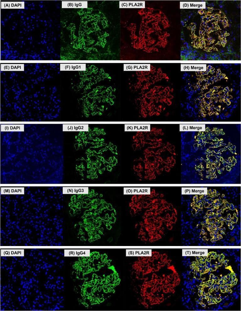 This composite of confocal light microscopy images illustrates immunofluorescence staining patterns in human glomerular tissue, specifically focusing on membranous nephropathy (MN). The 20-panel figure is organized into five rows (A-T), each representing a different IgG target: total IgG, IgG1, IgG2, IgG3, and IgG4. Within each row, four panels show: (1) DAPI nuclear staining in blue, (2) IgG or specific IgG subclasses in green, (3) PLA2R antigen in red, and (4) a merged overlay. The staining reveals a granular, loop-like distribution along the glomerular basement membrane (GBM), characteristic of subepithelial immune complex deposits. In the merged columns (D, H, L, P, T), the overlap of green (IgG) and red (PLA2R) signals produces a yellow color, demonstrating the co-localization of the PLA2R antigen with total IgG and all four IgG subclasses. DAPI staining confirms that these deposits are extracellular and distinct from cellular nuclei. This visual evidence supports the role of PLA2R as a major autoantigen in primary MN and characterizes the subclass composition of the associated immune deposits.