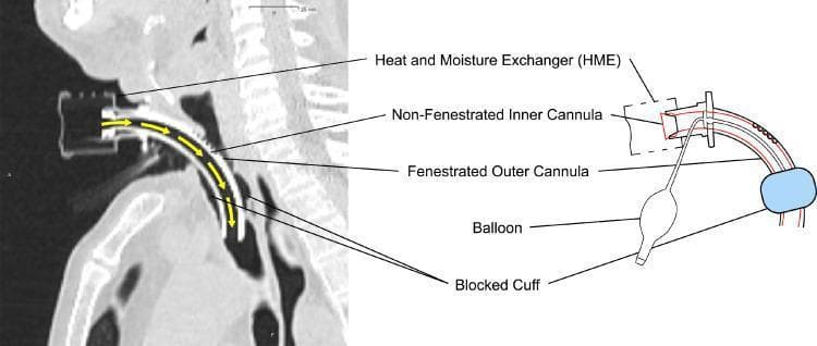 This composite educational graphic features a diagnostic sagittal CT scan and a corresponding anatomical schematic illustrating a tracheostomy tube setup in situ. The CT scan displays the tube inserted through a surgical stoma into the trachea, with yellow arrows indicating a unidirectional airflow pathway through the device. Key components identified include a non-fenestrated inner cannula nested within a fenestrated outer cannula. A Heat and Moisture Exchanger (HME) is attached to the proximal end. The schematic highlights the 'blocked cuff' or inflated pilot balloon, which creates a seal within the tracheal lumen to prevent peritubular air leakage. This configuration ensures that respiratory gases are directed exclusively through the inner cannula, bypassing the upper airway. This visual is designed to demonstrate how specific tracheostomy tube modifications, such as non-fenestrated inner cannulas and inflated cuffs, manage airflow and airway protection during medical procedures like radiation therapy.