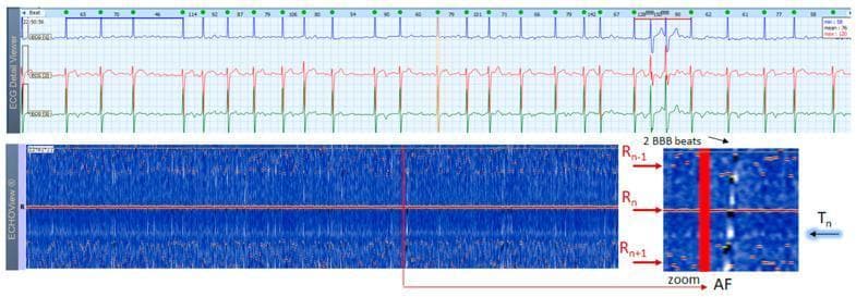 This diagnostic composite image displays a 3-lead Holter ECG strip (top) alongside a corresponding ECHOView color map (bottom), illustrating persistent atrial fibrillation (AF) in an 84-year-old male. The ECG strip shows characteristic rhythm irregularity with fluctuating heart rates between 46 and 150 bpm and prominent 'f' waves (gross AF). Two wide QRS complexes are visible, identified as aberrant ventricular conduction due to the Ashman phenomenon. The ECHOView panel transforms ECG amplitudes into a color-coded format. A central horizontal red line (Rn) represents aligned R-peaks. The irregularity of AF is demonstrated by the scattered, non-linear arrangement of red dots representing the previous (Rn-1) and subsequent (Rn+1) R-wave peaks. Notably, the stable blue-white band typically seen in sinus rhythm (representing P-waves) is absent; it is replaced by randomly distributed white dots corresponding to atrial fibrillatory waves. An inset zoom highlights these features and labels ventricular repolarization (Tn) as a blue-white trace. This visual tool aids in differentiating AF from other tachyarrhythmias like atrial flutter or multifocal atrial tachycardia by emphasizing P-wave absence and RR-interval variability.