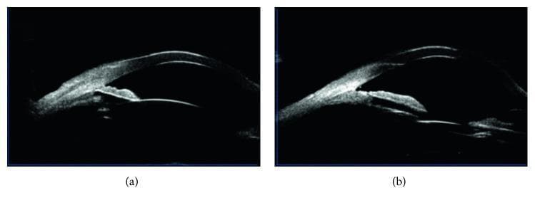 This Comparison Chart consists of two side-by-side Ultrasound Biomicroscopy (UBM) images of the anterior segment of a human eye, illustrating pre- and post-surgical changes in a patient with malignant glaucoma.
Image (a) displays a Diagnostic Image of the eye's anterior chamber before intervention. Key visible features include a shallow anterior chamber and the presence of peripheral anterior synechiae (PAS) where the peripheral iris is adhered to the trabecular meshwork, causing a closed anterior chamber angle. The iris contour appears relatively flat, indicating the absence of pupillary block.
Image (b) provides a postoperative comparison following goniosynechialysis and vitrectomy. It demonstrates a significant widening of the anterior chamber angle and an increase in central anterior chamber depth. The previously noted peripheral anterior synechiae are separated, and the iris is repositioned posteriorly, away from the cornea. This comparison highlights the restoration of the aqueous drainage pathway and the resolution of the anatomical crowding associated with aqueous misdirection syndrome (malignant glaucoma).