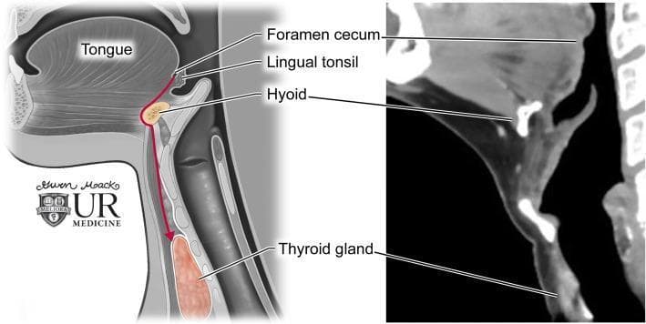 This dual-panel educational graphic illustrates thyroglossal duct anatomy and the embryological descent of the thyroid gland. On the left is a sagittal anatomical diagram showing the path of descent (indicated by a red arrow) from the foramen cecum at the base of the tongue, passing through the hyoid bone, to its final position at the thyroid gland anterior to the trachea. Key labeled structures include the tongue, lingual tonsil, foramen cecum, hyoid, and thyroid gland. The right panel displays a corresponding sagittal contrast-enhanced CT image of the neck. The CT scan highlights the radiologic appearance of these landmarks: the hyoid bone appears as a high-attenuation U-shaped structure, and the thyroid gland exhibits homogenous enhancement inferior to the thyroid cartilage. This comparison demonstrates the clinical relevance of embryological pathways in understanding the location of thyroglossal duct cysts, which can occur anywhere along this midline tract.