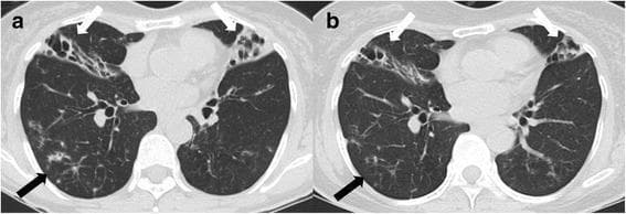 This figure presents two transverse chest computed tomography (CT) scans (axial view) illustrating the progression and treatment response of nontuberculous mycobacterial (NTM) lung disease. Scan (a) shows the initial presentation, characterized by bilateral bronchiectasis and pulmonary consolidations, specifically prominent in the right middle lobe and the lingular division of the left upper lobe (white arrows). Multiple 'tree-in-bud' opacities (black arrow) are visible in the peripheral lung zones, signifying active bronchiolitis and infectious small airway involvement. Scan (b) displays the same anatomical level after 12 months of antibiotic therapy, demonstrating a clear interval reduction in the density and extent of the consolidations (white arrows) and a significant decrease in the tree-in-bud appearances (black arrow). The images illustrate the classic radiographic features of the nodular bronchiectatic form of Mycobacterium abscessus infection and its typical response to targeted pharmacological intervention.