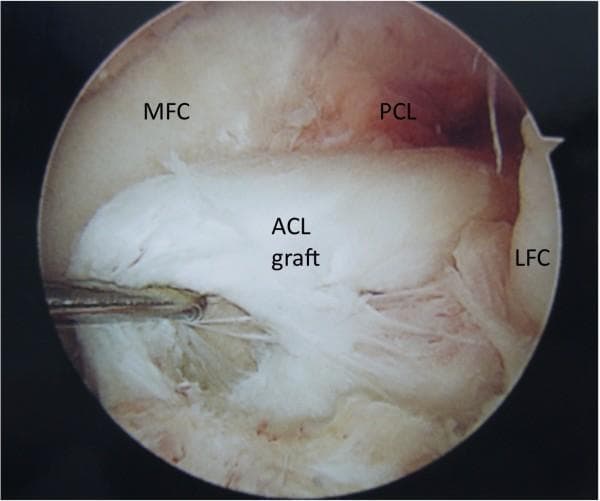 This clinical photograph shows an intra-operative arthroscopic view of the femoral notch in a left knee, specifically highlighting a failed anterior cruciate ligament (ACL) reconstruction. The central focus is a white, fibrous ACL graft which exhibits clear signs of rupture. The graft fibers are visibly frayed, disorganized, and disrupted, with the primary tear located near the distal tibial attachment site. The anatomical context is provided by several labeled landmarks: the medial femoral condyle (MFC) and lateral femoral condyle (LFC) appear as smooth, light-colored cartilaginous surfaces forming the walls of the notch. Posterior to the damaged ACL graft is the posterior cruciate ligament (PCL), which is covered by a vascularized, translucent synovial membrane. A surgical probe is visible on the left side, reflecting the clinical assessment of the graft's integrity. This image serves as a diagnostic example of mechanical failure in orthopedic sports medicine, specifically illustrating post-operative graft complications and the arthroscopic appearance of ligamentous fraying.