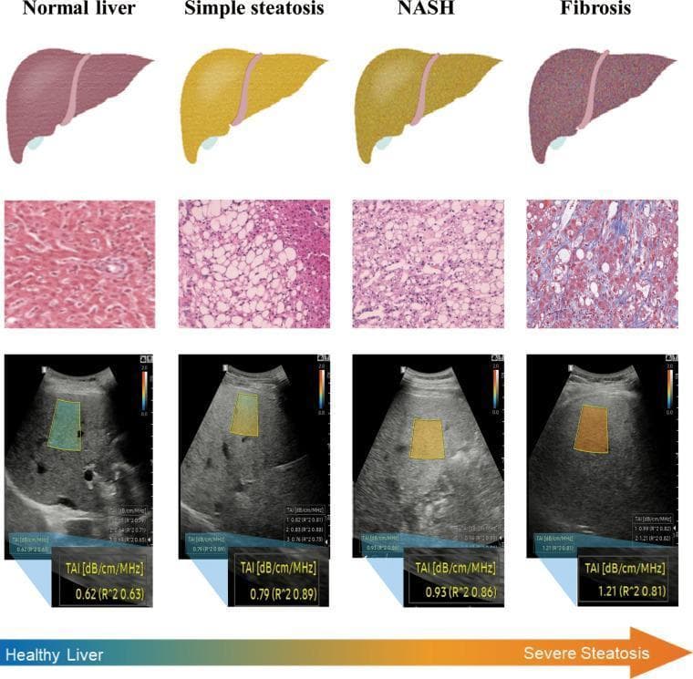A multi-modal comparison chart illustrating the progression of Non-alcoholic Fatty Liver Disease (NAFLD) across four stages: Normal liver, Simple steatosis, Non-alcoholic steatohepatitis (NASH), and Fibrosis. The top row shows gross anatomical illustrations where the liver transitions from a healthy reddish-brown to a pale yellowish-orange (steatosis/NASH) and finally a mottled purplish-brown (fibrosis). The middle row presents histological micrographs (H&E and Masson's Trichrome staining), highlighting the emergence of clear macrovesicular fat droplets in steatosis, inflammatory infiltration in NASH, and blue-stained collagen deposition in the fibrosis stage. The bottom row displays B-mode ultrasound images with Tissue Attenuation Imaging (TAI) overlays. As the disease severity increases from healthy to severe steatosis, the liver parenchyma exhibits increased echogenicity (brightness) and the quantitative TAI value rises sequentially from 0.62 to 1.21 dB/cm/MHz. This infographic serves as an educational tool for medical professionals to correlate gross morphology, cellular pathology, and diagnostic ultrasound parameters in hepatology.