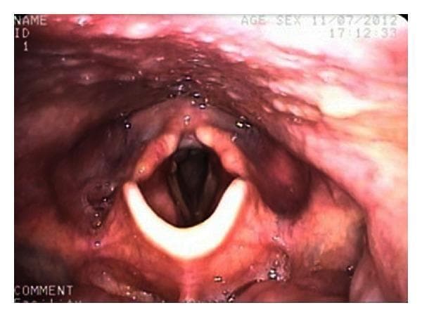 This clinical photograph displays an endoscopic view of the human larynx, specifically a fiberoptic nasoendoscopy. The image highlights the glottis and surrounding supraglottic structures. Centrally, the true vocal folds (vocal cords) appear as bright, pearly-white, crescent-shaped bands. The edges of the folds are smooth and symmetrical, framing the dark, patent rima glottidis (airway opening). Above the vocal folds, the vestibular folds (false vocal cords) and the laryngeal vestibule are visible, exhibiting a healthy, reddish-pink mucosal lining with normal vascularity. The epiglottis is partially visible at the top of the frame. Small droplets of clear mucus are scattered across the mucosal surface, which is a normal finding. This image serves as an educational example of normal post-traumatic recovery, demonstrating preserved laryngeal anatomy and unobstructed airway patency following a penetrating neck injury.