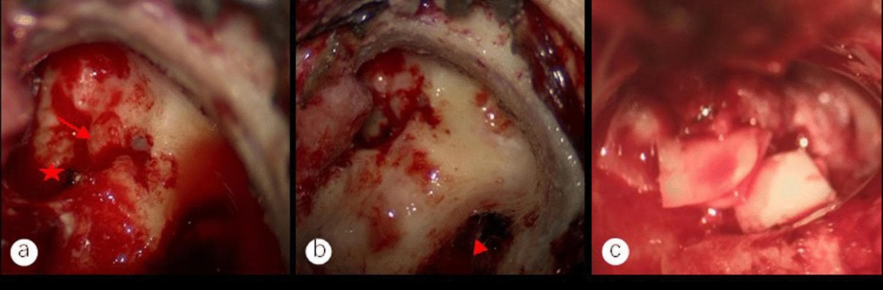 This composite of three intraoperative endoscopic clinical photographs demonstrates key steps in a modified mastoidectomy and tympanoplasty for middle ear cholesteatoma. Panel (a) shows the exposed facial nerve canal (red arrow) and the stapedial base (red star) after the removal of cholesteatoma epithelium. Hemorrhagic granulation tissue is visible near the stapes, which is managed via bipolar cautery to prevent recurrence. Panel (b) depicts the surgical exposure of the sigmoid sinus vein wall (red triangle) following mastoid bone removal, showing a preserved basilar membrane after the removal of overlying disease. Panel (c) illustrates the reconstruction phase, showing the placement of an auricular cartilage graft to restore the ossicular chain connection to the vestibular window (Type III tympanoplasty). These images highlight the surgical management of cholesteatoma involving critical neurovascular structures like the facial nerve and sigmoid sinus, emphasizing preservation of anatomical integrity while ensuring complete lesion eradication in an otolaryngology context.