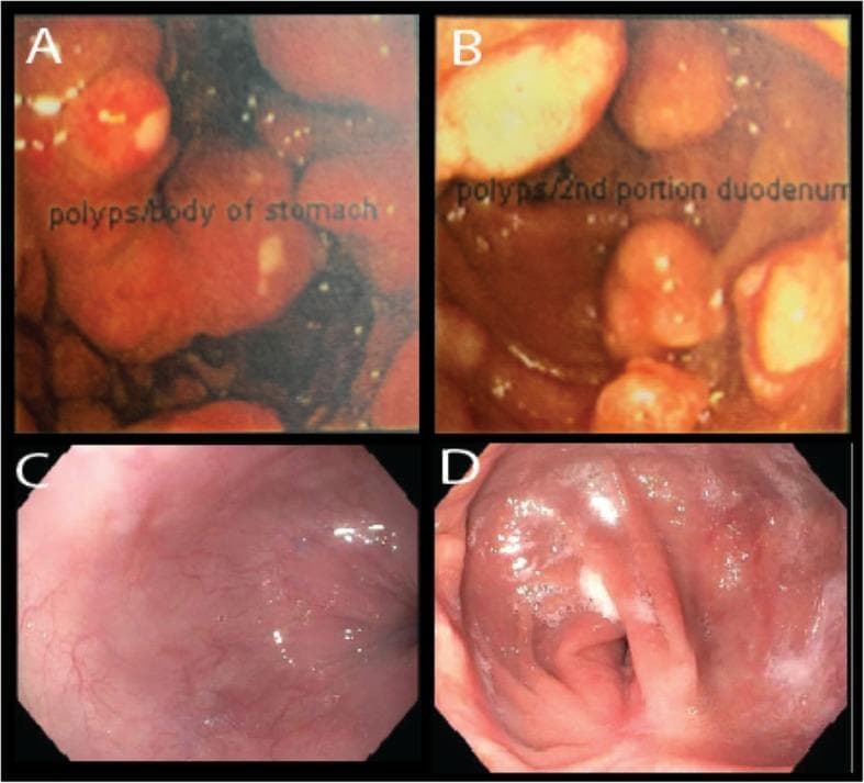 This composite of four endoscopic images illustrates the progression and treatment response of neuroendocrine tumors in a patient with Multiple Endocrine Neoplasia type 1 (MEN-1) and Zollinger-Ellison syndrome (ZES). Panels A and B (dated 2007) show large, multifocal, polypoid-appearing masses. Image A depicts nearly obstructing Enterochromaffin-like (ECL) carcinoid tumors in the gastric body, while Image B shows large gastrinomas in the proximal second portion of the duodenum. These tumors are characterized by a rounded morphology, protruding into the lumen with areas of superficial ulceration. Panels C and D (dated 2018) represent follow-up endoscopy after optimal surgical cytoreduction (near-total gastrectomy and pancreaticoduodenectomy) and medical management with octreotide. Image C shows the proximal stomach, and Image D shows the distal remnant stomach and small bowel anastomosis; both are completely devoid of carcinoid tumors or polyps, displaying smooth, healthy pink mucosa with normal vascular patterns. The comparison highlights the transition from aggressive, multifocal neuroendocrine neoplasia to successful long-term disease control.