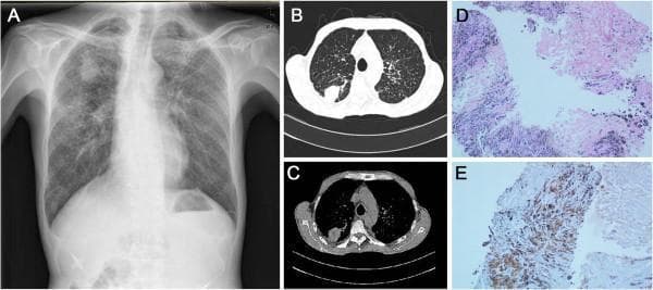 This composite image illustrates the radiological and histopathological presentation of pulmonary silicosis. Panel A is a posterior-anterior chest X-ray showing diffuse, small micronodular opacities throughout both lung fields and a prominent mass-like opacity in the right upper zone. Panels B and C are axial chest CT scans in lung and mediastinal windows, respectively, identifying a 25×33 mm consolidated nodule in the right upper lobe alongside widespread perilymphatic micronodularity. Panel D presents a Hematoxylin and Eosin (H&E) stained histopathological section from the biopsied lung nodule, demonstrating silicotic nodules characterized by dense fibrous tissue hyperplasia, hyaline degeneration, chronic inflammatory cell infiltration, and prominent black carbon (anthracotic) pigment deposits. Panel E shows immunohistochemical (IHC) staining, positive for CD163 (a histiocytic marker) and negative for CK (cytokeratin), supporting the diagnosis of a reactive/fibrotic process over malignancy. These findings are clinically relevant for diagnosing occupational pneumoconiosis, specifically silicosis with progressive massive fibrosis (PMF).