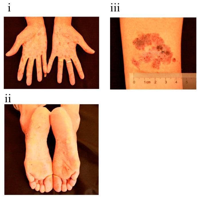 Clinical photographs showing dermatological manifestations of chronic arsenic poisoning in a single patient. Panel (i) displays the palms with diffuse, mottled pigmentation characterized by intermingled hyperpigmentation and de-pigmentation ('raindrop' appearance). Panel (ii) illustrates the soles of the feet exhibiting significant palmoplantar hyperkeratosis, appearing as thickened, yellowish, and rough skin localized primarily on weight-bearing areas. Panel (iii) presents a close-up of the right arm featuring a well-demarcated, erythematous, and scaly plaque approximately 3 cm in diameter, consistent with Bowen's disease (squamous cell carcinoma in situ). The plaque shows variegated color, including brownish-black pigmented areas and an irregular, rough surface texture. These visual signs are classic diagnostic indicators of long-term arsenic exposure, often leading to secondary cutaneous malignancies.