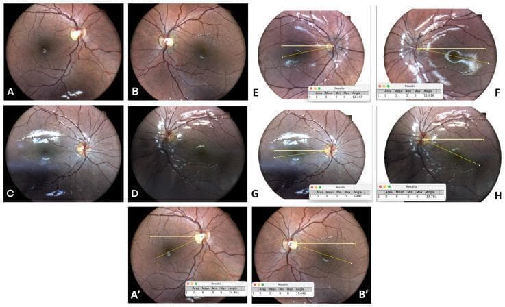 A multi-panel compilation of diagnostic fundus photographs illustrating various forms of strabismus and ocular torsion. Images A-D provide pre- and post-operative comparisons of the retina in cases of horizontal strabismus, showing the optic disc, macula, and retinal vasculature. Panels E-H and A'-B' utilize digital analysis software (ImageJ) to quantify ocular torsion, featuring yellow angular overlays that measure the disc-fovea angle. These quantitative frames demonstrate esotropia and exotropia with associated torsion, as well as severe torsion in a patient with craniosynostosis-related orbital abnormalities. The images highlight the clinical relationship between retinal landmark displacement (fundus torsion) and binocular vision disorders like strabismus and torsional amblyopia. Key features include the orientation of the vascular arcades and the relative vertical position of the fovea to the optic disc, which serves as a clinical indicator for diagnosing and measuring cyclodeviation in pediatric ophthalmology.