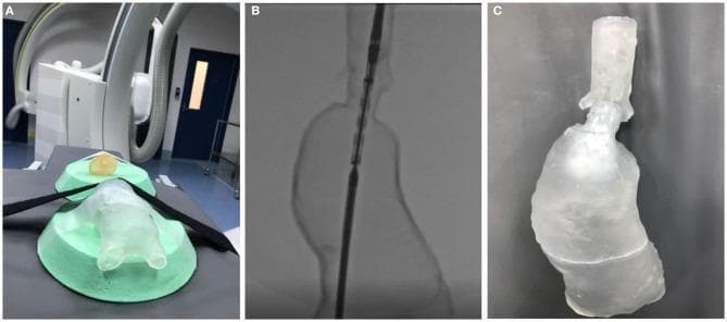 This composite image illustrates the application of 3D printing in vascular surgery simulation, specifically for abdominal aortic aneurysm (AAA) repair. Panel A shows a transparent, 3D-printed AAA phantom, manufactured using Stereolithography (SLA) resin, positioned on a clinical fluoroscopy table in preparation for an endovascular procedure simulation. Panel B displays a fluoroscopic diagnostic image of the same phantom, demonstrating its radiolucency and the high-contrast visualization of an intravascular catheter and a developing stent graft. This highlights the model's utility in mimicking real-time intraoperative imaging. Panel C presents the post-procedural model, showcasing the successful deployment of a fenestrated stent graft within the transparent aneurysm sac. The series demonstrates the process of using patient-specific vascular models for preoperative planning and simulation of complex fenestrated endovascular aneurysm repair (EVAR), facilitating anatomical insight and procedural practice in a risk-free environment.