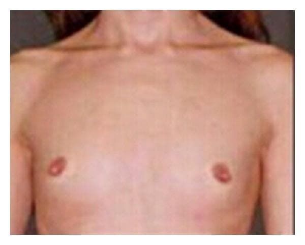 This clinical photograph shows the anterior upper torso of a 21-year-old patient, illustrating a significant lack of secondary sexual characteristics in the breast region. The chest wall appears flat with an absence of glandular breast tissue development (breast hypoplasia or amastia-like appearance). The nipple-areolar complexes are present but small and undeveloped, consistent with a low Tanner stage (B1-B2). The skin over the thorax is unremarkable, with no visible lesions, though the subcutaneous fat layer appears thin. In the context of the provided clinical history, these findings are indicative of delayed puberty or an underlying endocrinological/genetic condition such as primary amenorrhea and Disorders of Sex Development (DSD). The image serves as a clinical reference for evaluating Tanner staging and the physical manifestations of hormonal imbalances or androgen insensitivity syndromes in an adult female-presenting patient.
