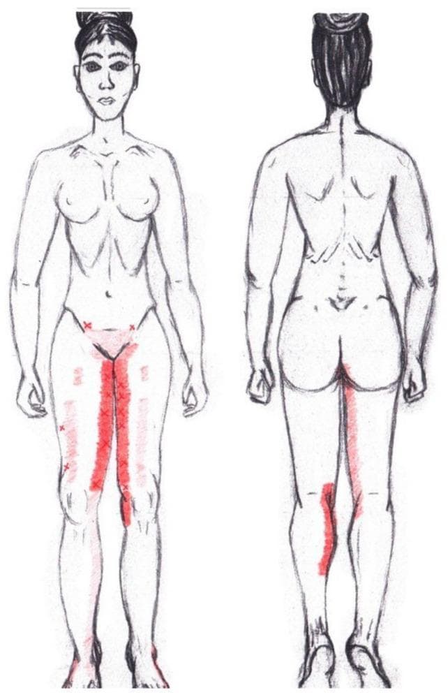 This medical illustration is a graphical simulation of myofascial referred pain patterns associated with the adductor magnus muscle, presented on a female body schematic in anterior and posterior views. The diagram uses red color mapping to indicate pain distribution and frequency. In the anterior view, primary referred pain is depicted as intense, vertical red bands along the bilateral medial thighs, extending from the groin to the superior aspect of the knees. Faint red patches and 'X' markers on the lateral and superior thighs indicate areas of less frequent or secondary referred pain. In the posterior view, the simulation identifies a significant referred pain area on the superior-medial aspect of the right calf. The color intensity serves as a semi-quantitative scale, where more vibrant red highlights common clinical trigger point referral zones. This educational visual is designed for physical therapy, anatomy education, and clinical diagnostic training related to musculoskeletal pain syndromes and pelvic floor dysfunction.