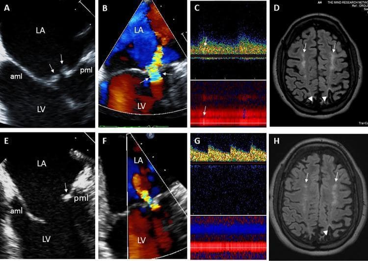 This composite figure illustrates the multi-organ manifestations and treatment response of Libman-Sacks endocarditis. Panels A and B are transesophageal echocardiography (TEE) images showing sessile, oval-shaped vegetations (arrows) on the atrial side of the anterior (aml) and posterior (pml) mitral leaflets, accompanied by a large flow convergence zone indicating moderate to severe eccentric mitral regurgitation. Panel C displays a transcranial Doppler (TCD) showing high-intensity transient signals suggestive of microemboli in the left middle cerebral artery. Panel D is an axial T2-FLAIR brain MRI demonstrating white matter hyperintensities (arrows) and cortical infarcts (arrowheads). Panels E through H represent follow-up imaging after 3 months of immunosuppressive and anticoagulant therapy. These show partial resolution of the mitral vegetations (E), a significant reduction in the mitral regurgitation jet (F), clearance of cerebral microemboli on TCD (G), and a reduction in the total burden and size of white matter lesions and infarct visibility on MRI (H). This clinical comparison highlights the systemic embolic potential of non-bacterial thrombotic endocarditis (NBTE) in the context of systemic lupus erythematosus.