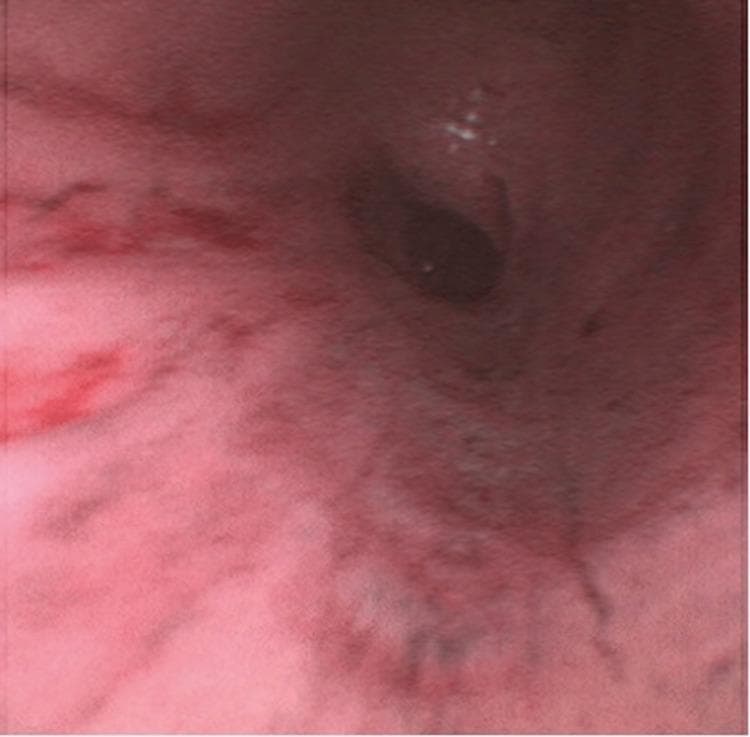 This bronchoscopic image shows the distal airway of a patient with severe inhalation injury. The primary finding is a denuded and erythematous epithelium, where the normal smooth mucosal lining has sloughed off due to thermal or chemical damage. The underlying tissue appears raw, swollen, and predominantly red, indicating significant inflammation and vascular congestion. A focal dark lesion or area of soot deposition is visible within the lumen, further characterizing the severity of the injury. The clinical presentation is consistent with a high-grade inhalation injury, commonly seen in burn patients. This image demonstrates the rapid progression from initial mucosal blistering to circumferential epithelial denudation, a critical factor in airway management and the pathophysiology of post-burn respiratory complications.