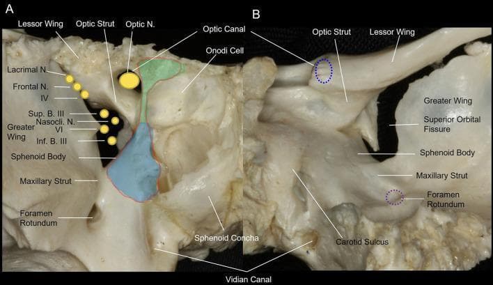 This medical anatomical diagram features two clinical photographs of a dry bone specimen, showing the osseous anatomy of the human orbital apex of the sphenoid bone. Image (A) provides an anterior view, highlighting the optic canal superomedially and the superior orbital fissure (SOF) inferolaterally. Key landmarks include the optic strut, which separates the optic nerve and ophthalmic artery from the SOF contents, and the maxillary strut, which separates the SOF from the foramen rotundum. Overlays illustrate the surgical decompression areas: the light green area denotes the medial wall of the optic canal, and the light blue area indicates the medial wall of the SOF. Image (B) presents a posterior view, showing the spatial relationship between the optic canal, SOF, foramen rotundum, and the carotid sulcus. The diagram identifies neurovascular structures passing through these apertures, including the optic nerve (CN II), oculomotor nerve (CN III), trochlear nerve (CN IV), and divisions of the trigeminal nerve (V1, V2). This resource is designed for advanced surgical planning in endoscopic endonasal decompression procedures.