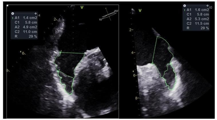 This diagnostic image consists of two side-by-side transesophageal echocardiography (TEE) views demonstrating the assessment of a thrombus within the left atrial appendage (LAA). The left pane shows a view at approximately 157 degrees, while the right pane shows a complementary projection. In both images, green dashed planimetry lines delineate the boundaries of the LAA (A2) and the specific area occupied by an intra-cavitary thrombus (A1). The thrombus appears as a discrete, hypoechoic mass localized within the distal portion of the appendage. On-screen data boxes provide quantitative measurements: Area 1 (A1) represents the thrombus area, and Area 2 (A2) represents the total LAA area. The calculated ratio (R) in both projections indicates that the thrombus occupies approximately 29% of the LAA area. This diagnostic approach is critical for pre-procedural planning in Percutaneous Left Atrial Appendage Closure (PLAAC) for patients with atrial fibrillation and high thromboembolic risk, as it allows for the characterization of thrombus size and volume relative to the landing zone of the occluder device.