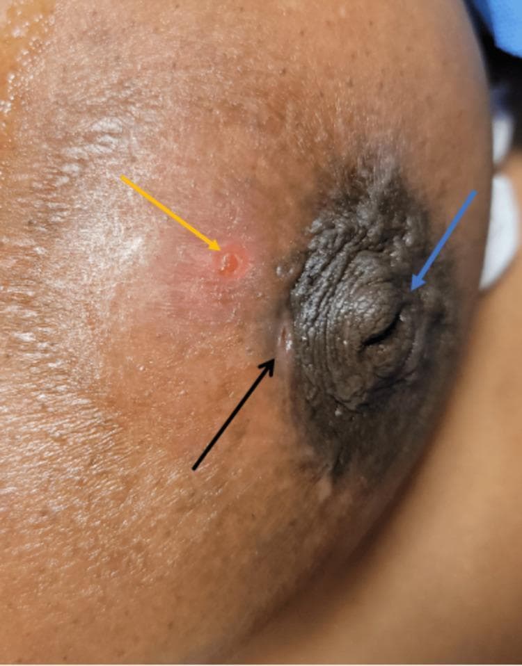 This clinical photograph displays a lateral view of a human breast, focusing on the nipple-areolar complex (NAC) to illustrate findings characteristic of Zuska's disease (recurrent subareolar abscess). Three key clinical features are highlighted with colored arrows: A blue arrow points to a significant nipple inversion, where the nipple is retracted into the areola. A black arrow indicates a periareolar draining fistula located at the vermillion border of the areola, appearing as a small, slit-like opening. A yellow arrow identifies a localized area of skin thinning and erythema peripheral to the areola, representing the site of an underlying subareolar abscess. The surrounding skin shows secondary signs of inflammation, including redness and swelling. This image serves as a textbook example of the triad of nipple inversion, recurrent abscess, and fistulization used in diagnosing chronic periductal mastitis and related breast infections.