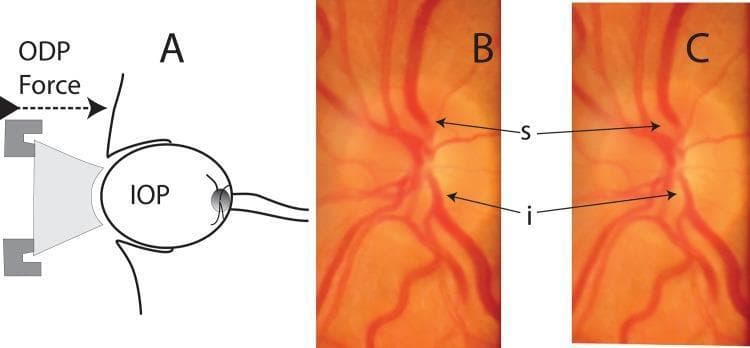 This composite educational graphic illustrates the principles and clinical observation of ophthalmodynamometry. Panel A is a schematic diagram showing an ophthalmodynamometer applying external force (ODP) to the globe, which interacts with the baseline intraocular pressure (IOP) to determine venous pulsation pressure. Panels B and C are high-magnification clinical photographs of the optic disc and peripapillary retina, specifically highlighting the superior (s) and inferior (i) hemi-veins. Panel B demonstrates the dilation phase of retinal venous pulsation, where the vessels appear wider and more engorged. Panel C demonstrates the collapse phase of the same pulsation cycle, showing the hemi-veins in a narrower, constricted state. This visual comparison is used to teach the identification of spontaneous or induced venous pulsation, a critical clinical marker in the assessment of intracranial pressure and glaucoma. The set serves as a guide for ophthalmology residents to understand how external pressure influences retinal vascular dynamics and how to visually distinguish between the peak and trough of the venous pulse.