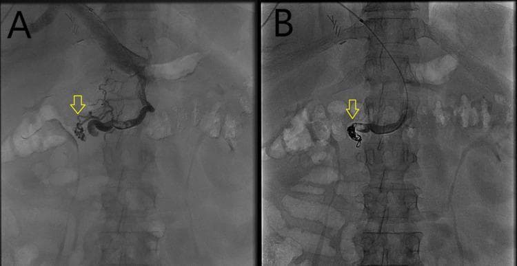 Dual-panel fluoroscopic imaging of the abdomen demonstrating the interventional management of ectopic varices in a patient with portal hypertension. Figure A (pre-embolization) shows an anteroposterior fluoroscopic view with a contrast-enhanced cluster of dilated, tortuous, and irregular venous structures (indicated by a yellow arrow) in the duodenal region. These duodenal varices are supplied by a portosystemic shunt involving the superior mesenteric vein. Figure B (post-embolization) illustrates the results of transhepatic coil embolization. Dense, radiopaque metallic coils are now visible within the variceal nest (indicated by the yellow arrow), effectively occluding the abnormal vessels. A catheter used for the intervention is visible traversing the mid-abdomen. These images highlight the role of interventional radiology in treating rare sites of variceal bleeding associated with cirrhosis and portal hypertension when conventional endoscopic therapy is insufficient.