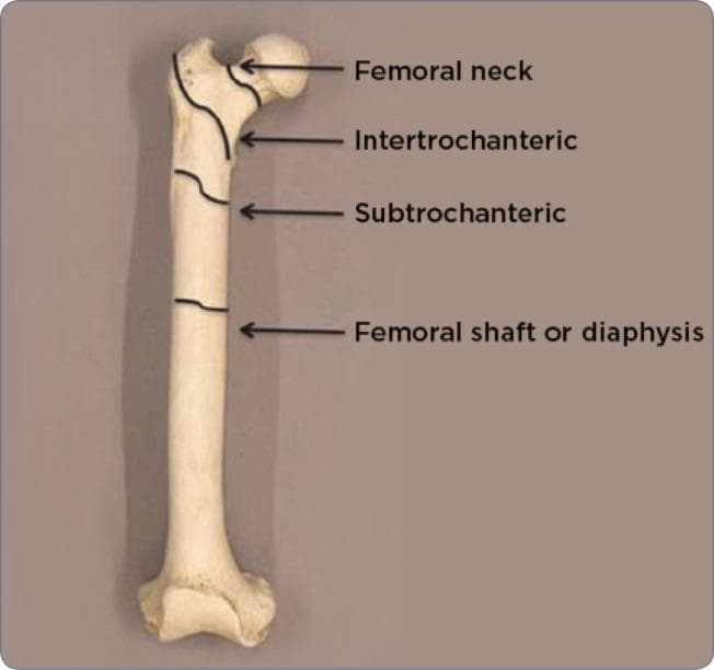 An anatomical diagram of a human femur bone, presented on a neutral background to illustrate common fracture sites and regional anatomy. The image identifies four primary proximal and mid-shaft regions using black labels and arrows. Starting from the proximal end, the 'Femoral neck' is indicated between the femoral head and the trochanters. Immediately distal to this is the 'Intertrochanteric' region, spanning the space between the greater and lesser trochanters. Below this lies the 'Subtrochanteric' region, representing the transition into the main body of the bone. Finally, the long, central portion is labeled as the 'Femoral shaft or diaphysis'. This illustration serves as an educational tool for medical professionals to classify orthopedic injuries, such as hip fractures or atypical femoral fractures (AFF), by precisely defining anatomical zones. The diagram emphasizes the proximal femur’s morphology, including the head, neck, and trochanteric areas, which are critical in radiology and surgical planning.