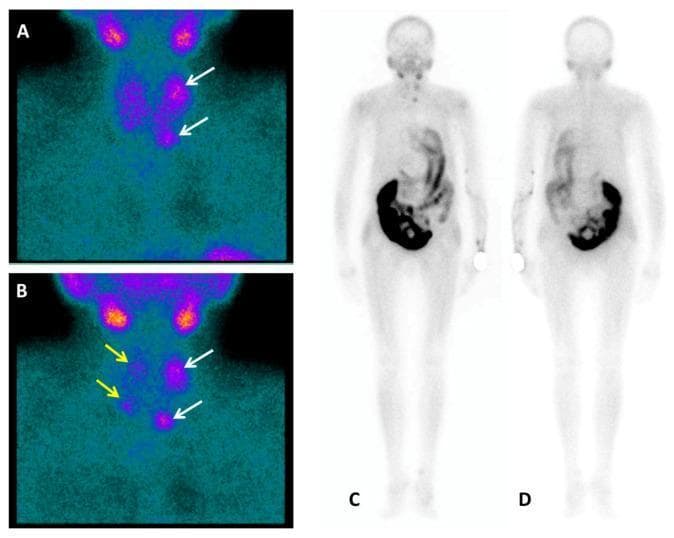 Diagnostic nuclear medicine imaging featuring Tc-99m-Sestamibi (MIBI) planar scintigraphy for the evaluation of tertiary hyperparathyroidism. Panels A and B display dual-phase anterior neck views. Early acquisition (A) shows initial radiotracer uptake in the thyroid and left superior/inferior parathyroid glands (white arrows). Delayed acquisition (B) demonstrates characteristic thyroid washout with persistent focal uptake in the left parathyroid glands and emerging mild concentration in the right parathyroid glands (yellow arrows), suggesting multiglandular hyperplasia or adenomas. Panels C (anterior) and D (posterior) show whole-body planar scans. These images reveal physiological tracer distribution, notably intense uptake in the abdominal digestive organs, while specifically demonstrating an absence of tracer accumulation in the skeletal system. The study highlights the diagnostic use of MIBI scintigraphy to differentiate hyperfunctioning parathyroid tissue from thyroid tissue and to screen for metabolic bone involvement in patients with chronic renal failure and elevated PTH levels.